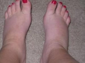 solutions-of-foot-swelling-after-pregnancy-1