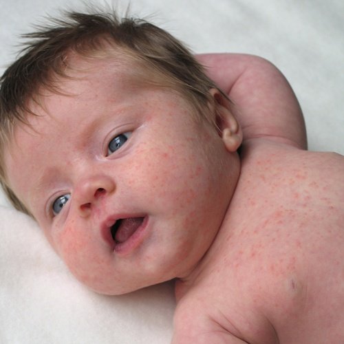 causes-allergies-babies