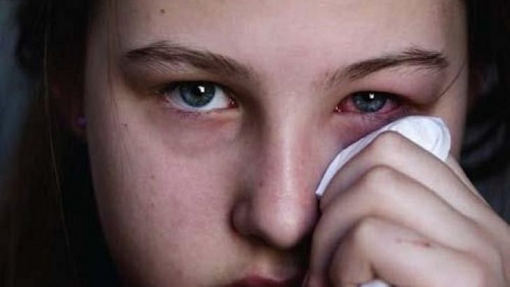 About Eye Fever
