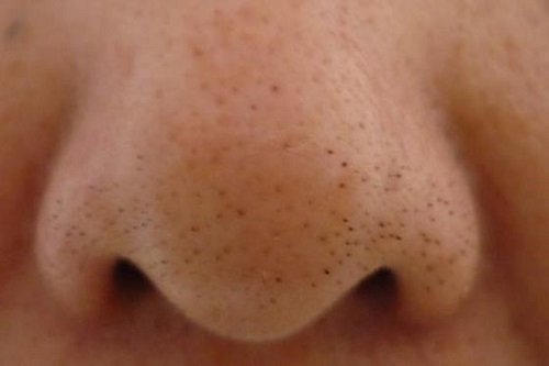 About Nose Pore  