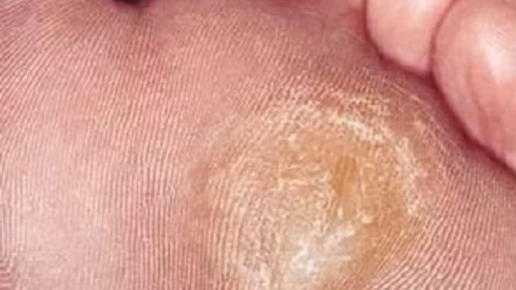 Callus Herbal Treatment